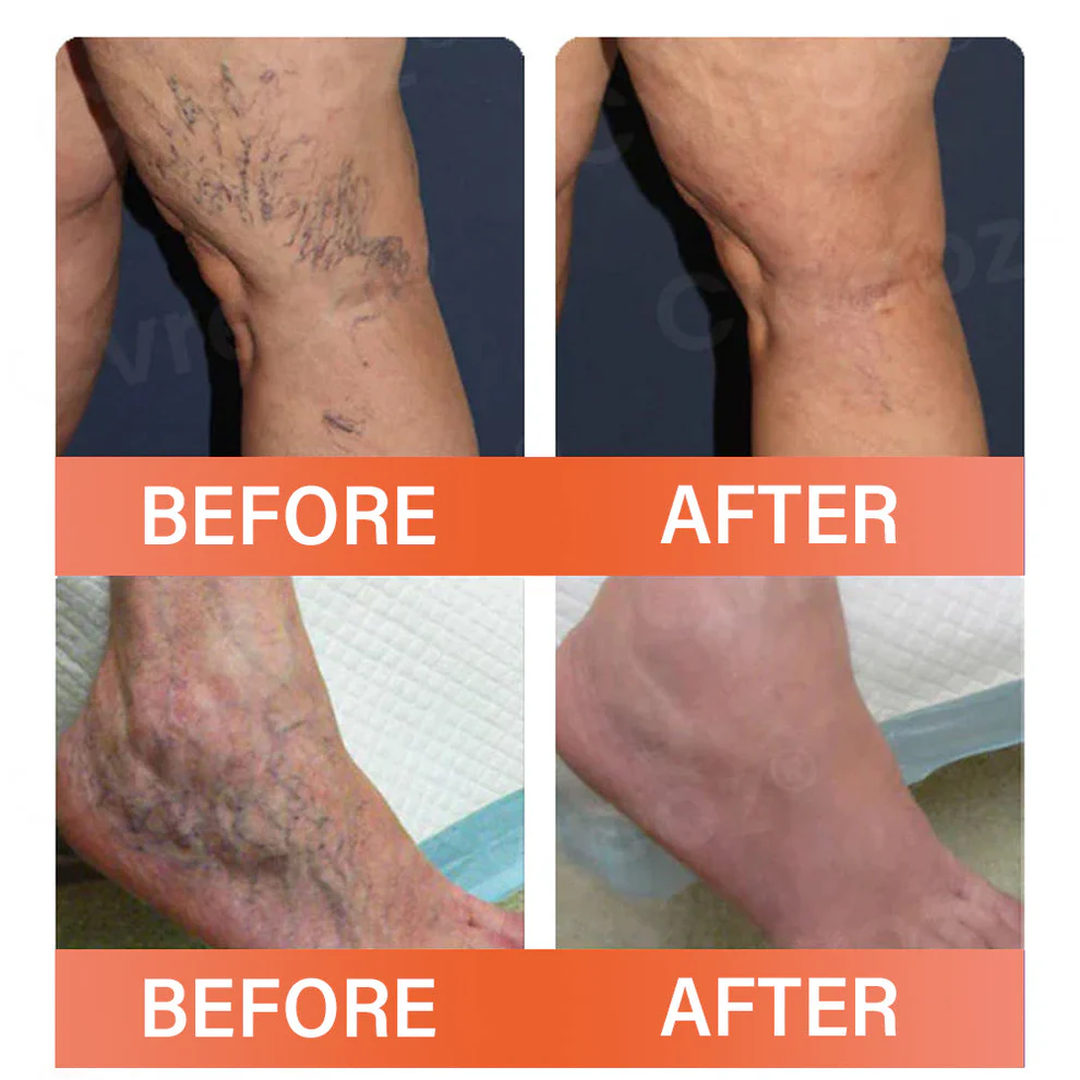 Oveallgo® VeinEase Microneedle Therapy Patch 3 Oveallgo® VeinEase Microneedle Therapy Patch