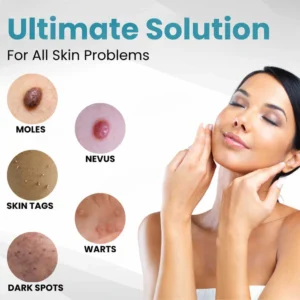 Lovilds® Non-Invasive Mole and Wart Removal Laser Pen 10 Lovilds® Non-Invasive Mole and Wart Removal Laser Pen