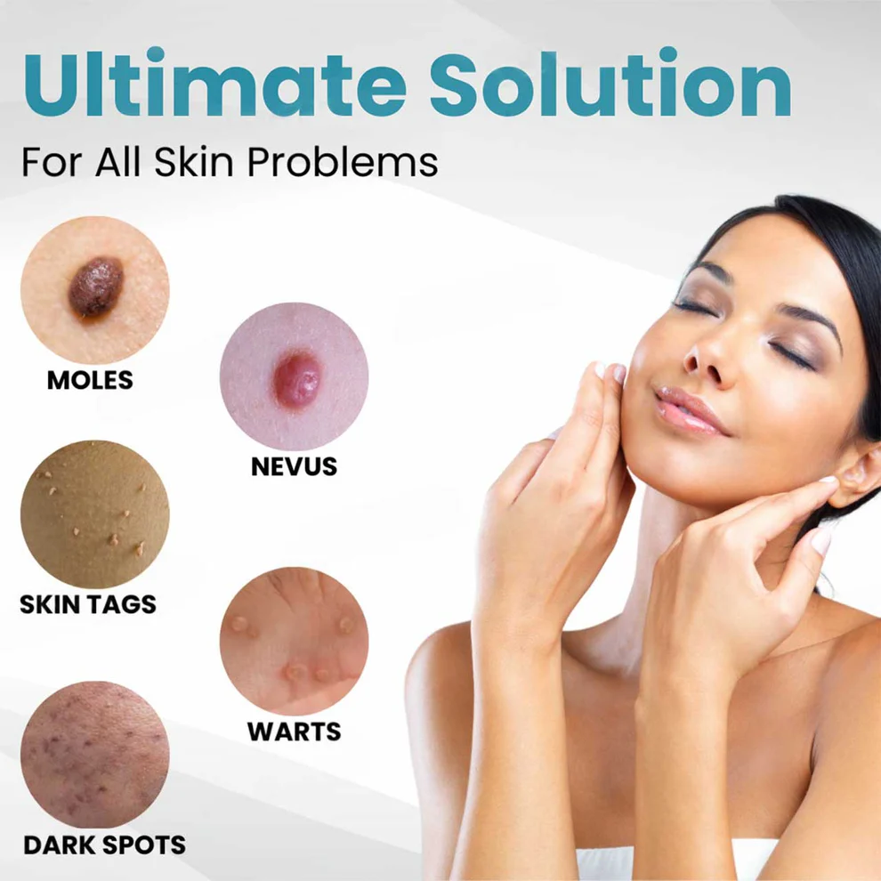 Lovilds® Non-Invasive Mole and Wart Removal Laser Pen 3 Lovilds® Non-Invasive Mole and Wart Removal Laser Pen