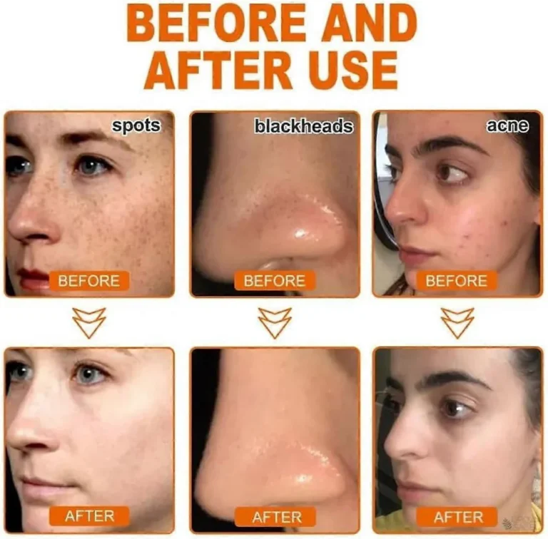 LOVILDS™ Whitening and Freckle – Removing Mask 11 LOVILDS™ Whitening and Freckle – Removing Mask