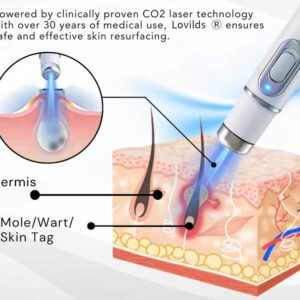 Lovilds® Non-Invasive Mole and Wart Removal Laser Pen 15 Lovilds® Non-Invasive Mole and Wart Removal Laser Pen