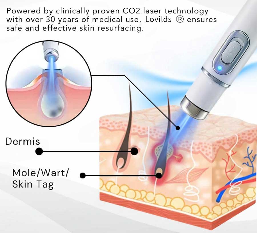 Lovilds® Non-Invasive Mole and Wart Removal Laser Pen 8 Lovilds® Non-Invasive Mole and Wart Removal Laser Pen