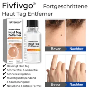 Fivfivgo® Bee Venom Tags & Moles Remover 6 Fivfivgo® Bee Venom Tags & Moles Remover