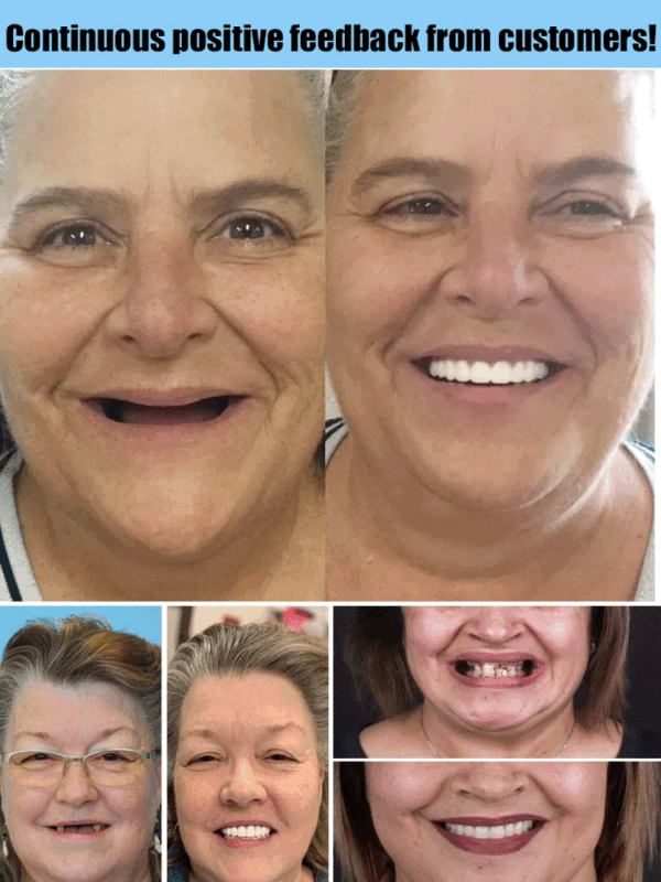 Hidone® Advanced Customized Full Denture Set 14 Hidone® Advanced Customized Full Denture Set