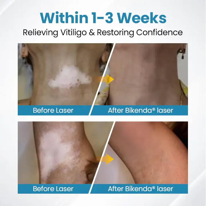 Bikenda® DermaBeam Vitiligo Therapy Device 3 Bikenda® DermaBeam Vitiligo Therapy Device