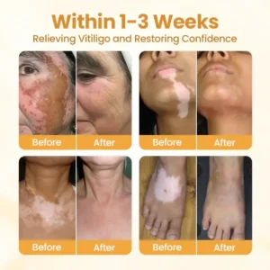 BBOJI™ VitiClear Pro Bee Toxin Cream 12 BBOJI™ VitiClear Pro Bee Toxin CreamBBOJI™ VitiClear Pro Bee Toxin Cream