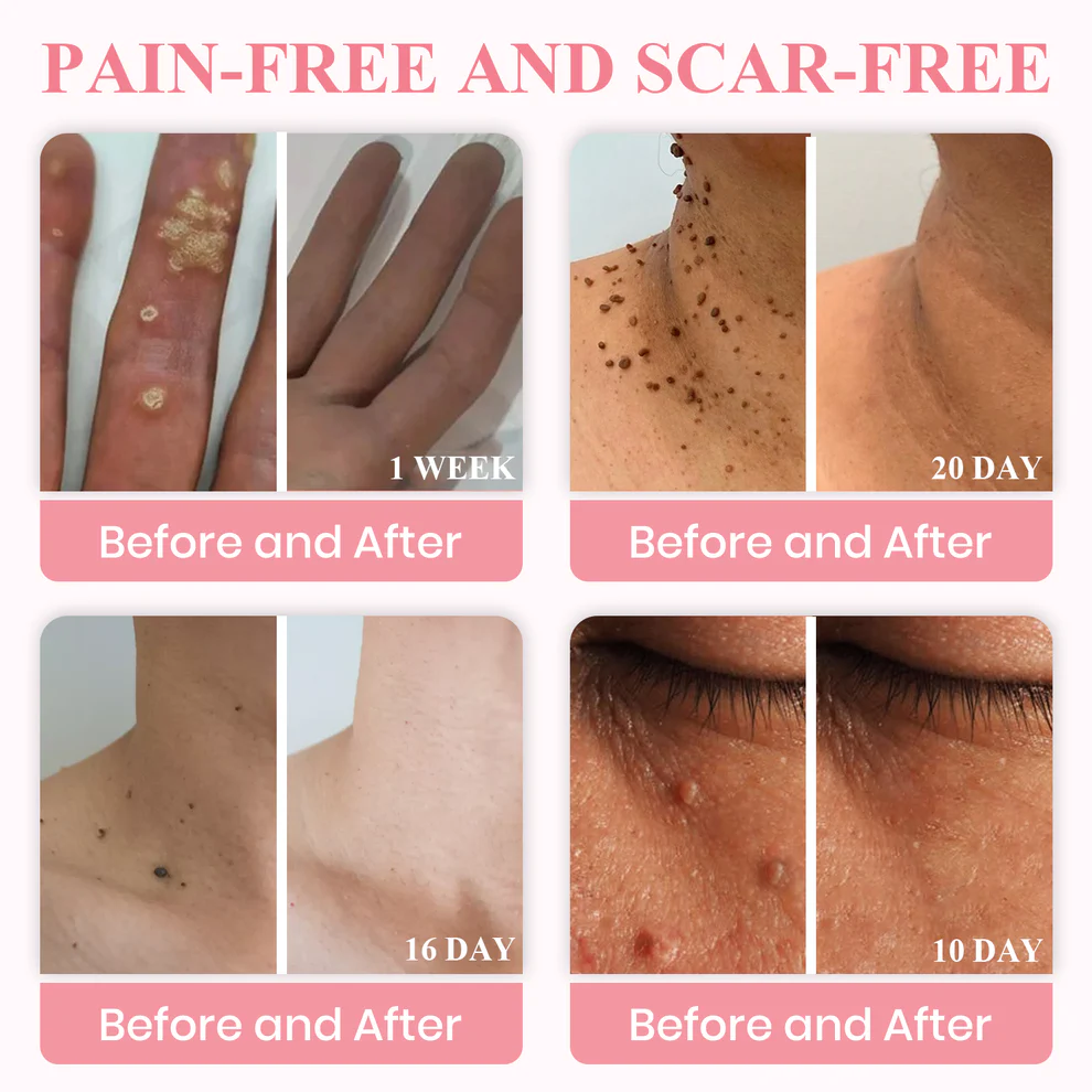 LUHAKA® Dual Acid Wart & Mole Removal Serum 4 LUHAKA® Dual Acid Wart & Mole Removal Serum