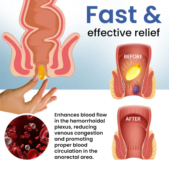 Cvreoz® Natural Hemorrhoid Capsules 4 Cvreoz® Natural Hemorrhoid Capsules