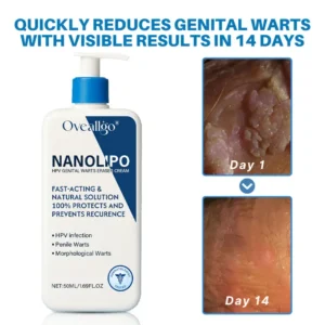 Oveallgo® NanoLipo HPV Genital Warts Eraser Cream Ultra 11 Oveallgo® NanoLipo HPV Genital Warts Eraser Cream Ultra