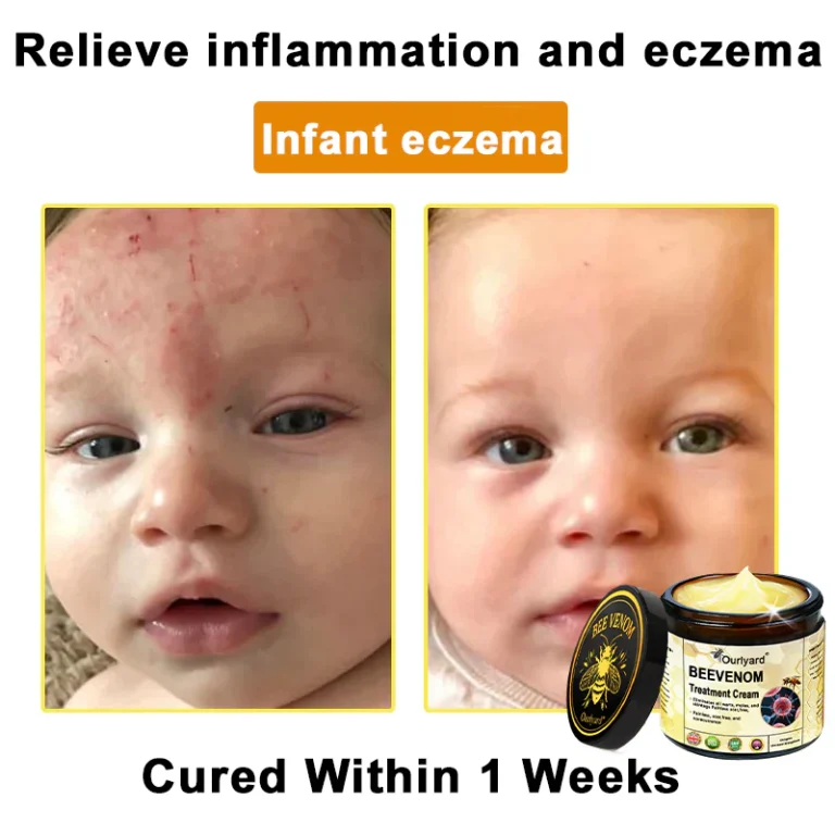 Ourlyard® Botulinum Toxin & Bee Venom Skin Treatment Cream 2 Ourlyard® Botulinum Toxin & Bee Venom Skin Treatment Cream