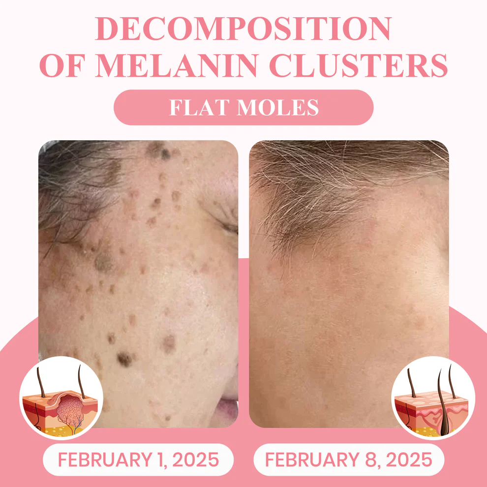 LUHAKA® Dual Acid Wart & Mole Removal Serum 7 LUHAKA® Dual Acid Wart & Mole Removal Serum