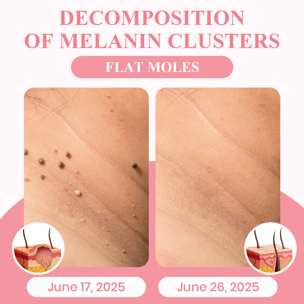 LUHAKA® Dual Acid Wart & Mole Removal Serum 9 LUHAKA® Dual Acid Wart & Mole Removal Serum