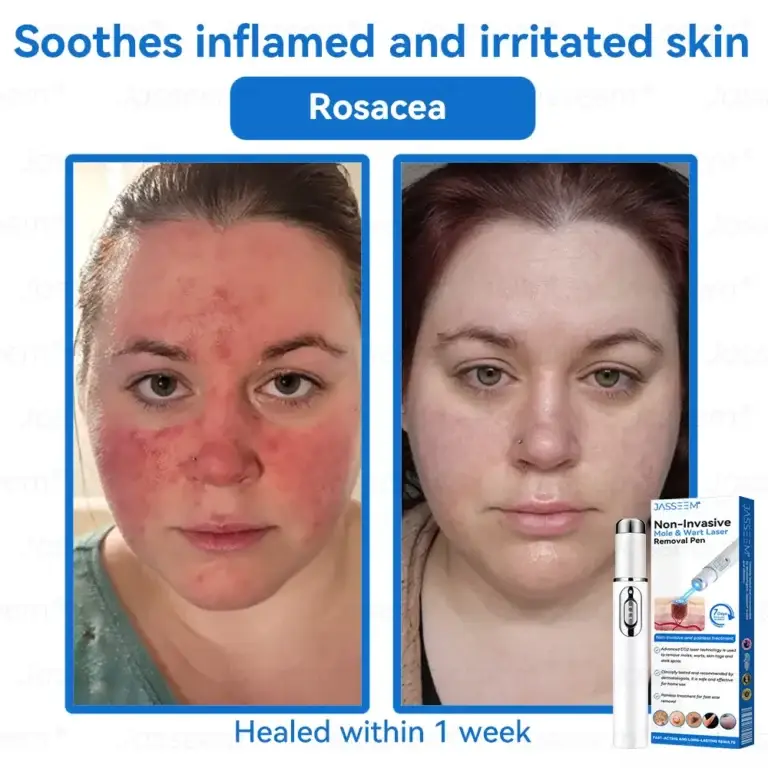 Jasseem® Non-Invasive Mole & Wart Laser Removal Pen 7 Jasseem® Non-Invasive Mole & Wart Laser Removal Pen