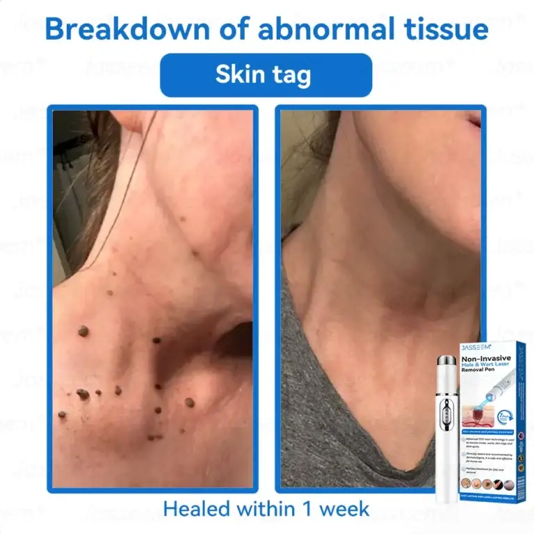 Jasseem® Non-Invasive Mole & Wart Laser Removal Pen 6 Jasseem® Non-Invasive Mole & Wart Laser Removal Pen