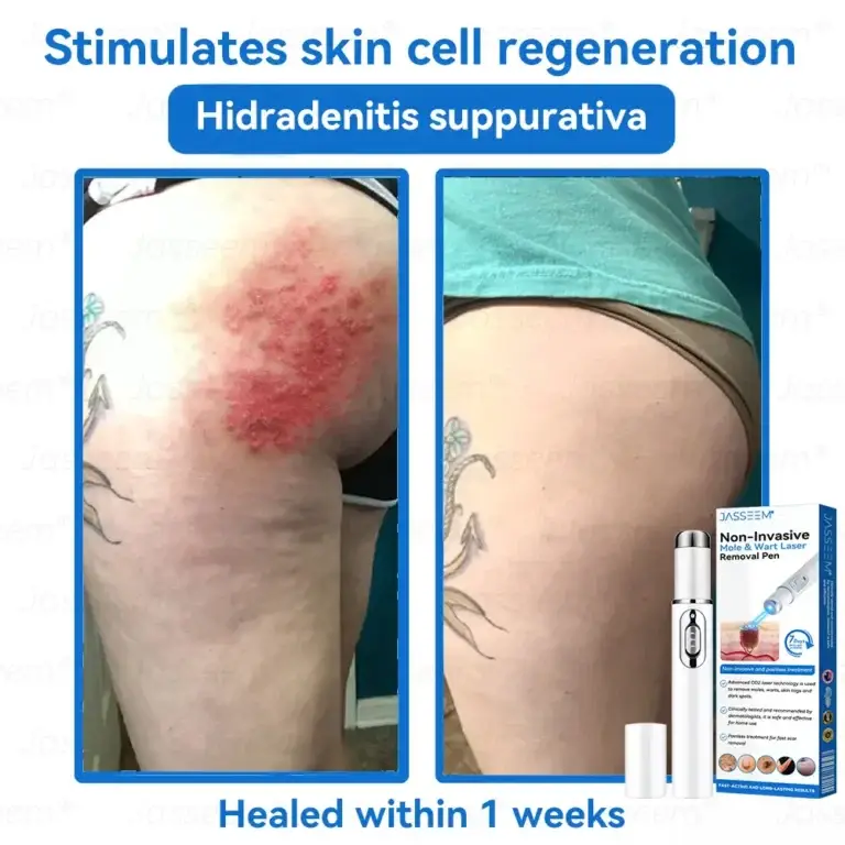 Jasseem® Non-Invasive Mole & Wart Laser Removal Pen 5 Jasseem® Non-Invasive Mole & Wart Laser Removal Pen