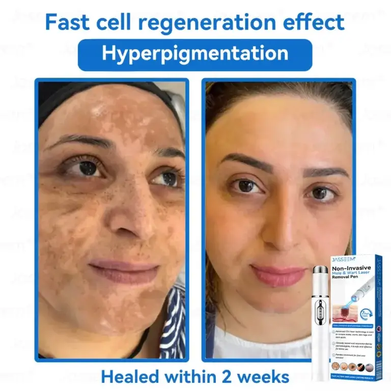 Jasseem® Non-Invasive Mole & Wart Laser Removal Pen 4 Jasseem® Non-Invasive Mole & Wart Laser Removal Pen