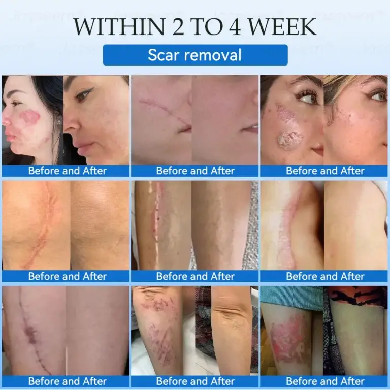 Jasseem® Non-Invasive Mole & Wart Laser Removal Pen 12 Jasseem® Non-Invasive Mole & Wart Laser Removal Pen