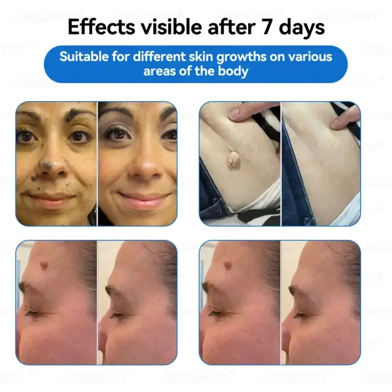 Jasseem® Non-Invasive Mole & Wart Laser Removal Pen 10 Jasseem® Non-Invasive Mole & Wart Laser Removal Pen