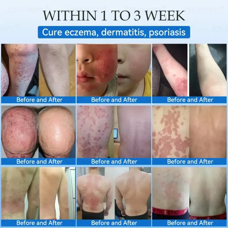 Jasseem® Non-Invasive Mole & Wart Laser Removal Pen 9 Jasseem® Non-Invasive Mole & Wart Laser Removal Pen