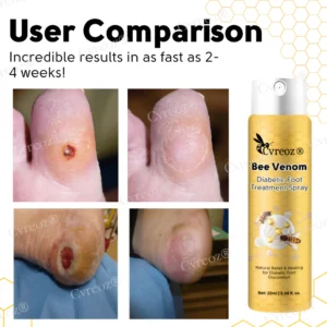 Cvreoz® Bee Venom Diabetic Foot Treatment Spray 14 Cvreoz® Bee Venom Diabetic Foot Treatment Spray
