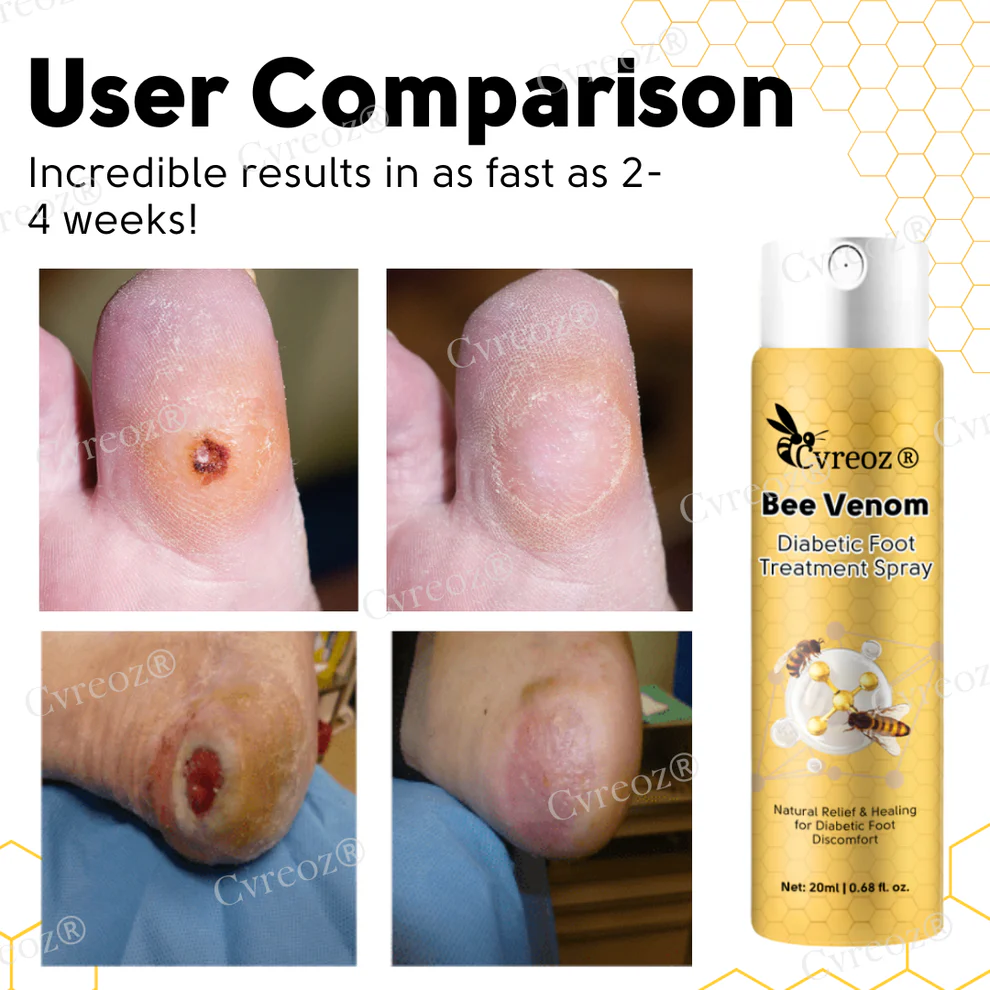 Cvreoz® Bee Venom Diabetic Foot Treatment Spray 7 Cvreoz® Bee Venom Diabetic Foot Treatment Spray