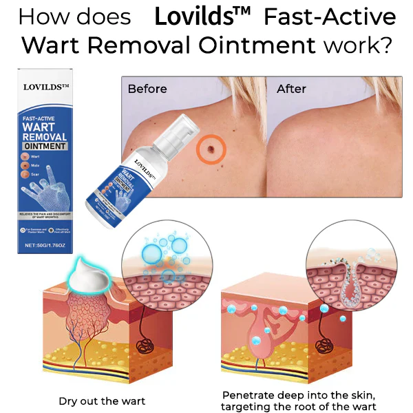 LOVILDST™ Fast-Active Wart Removal Ointment 5 LOVILDST™ Fast-Active Wart Removal Ointment