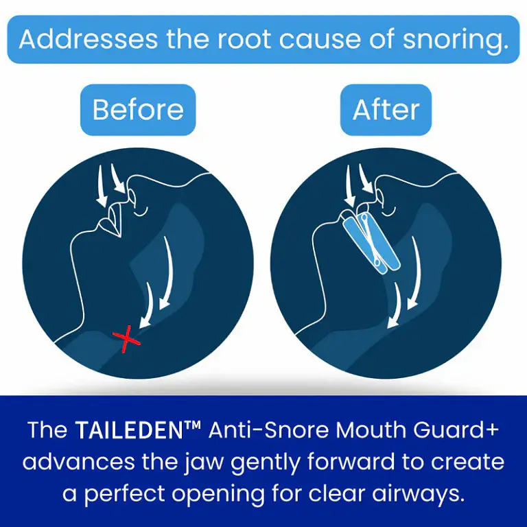 TAILEDEN™ Anti-Snore Mouth Guard+ 6 TAILEDEN™ Anti-Snore Mouth Guard+