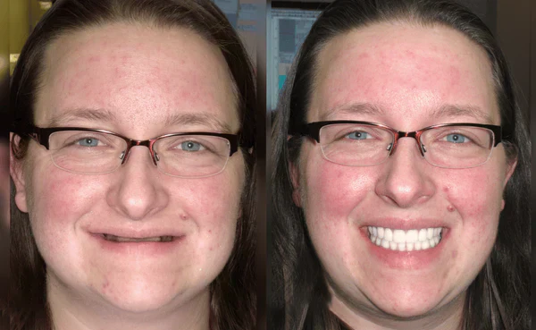 HZA™ Custom-Fit Functional Dentures 8 HZA™ Custom-Fit Functional Dentures