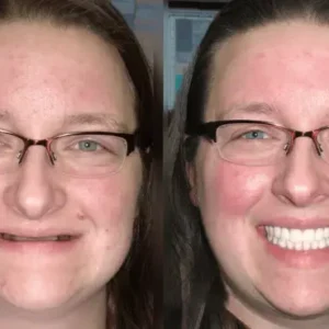 AQA™ Advanced Customized Full Denture Set 19 AQA™ Advanced Customized Full Denture Set