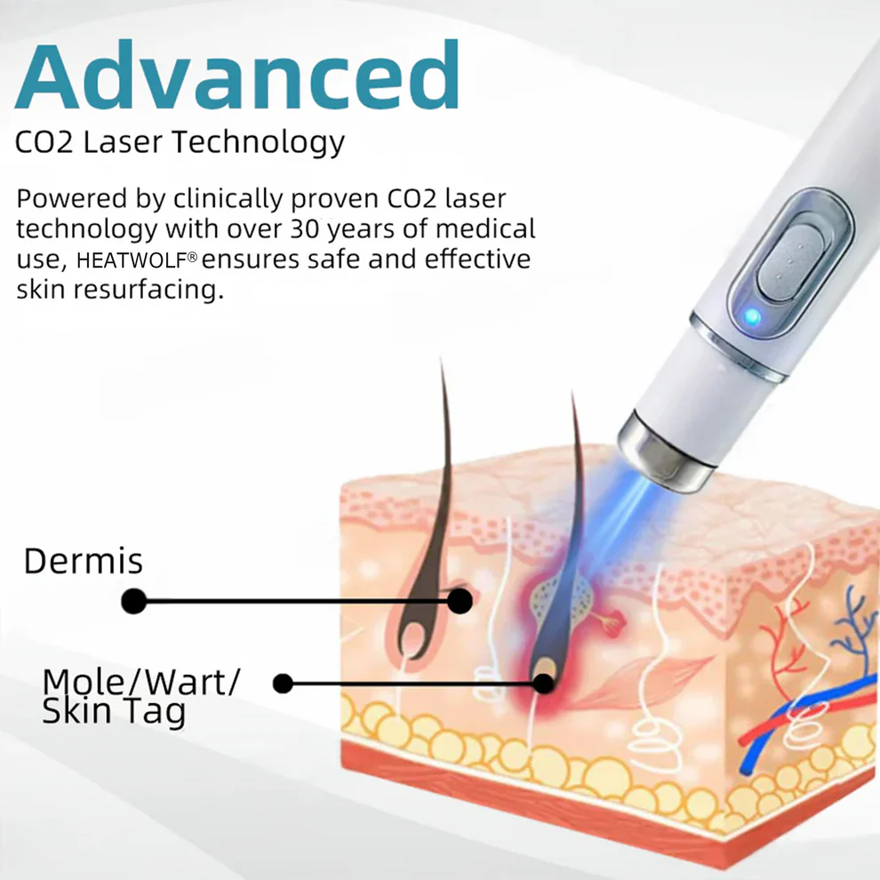 Cougex® Non-invasive Mole & Wart Removal Laser Pen 10 Cougex® Non-invasive Mole & Wart Removal Laser Pen