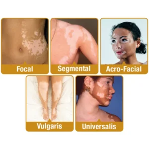 Dobshow™ BeeVenom Vitiligo Treatment Cream 21 Dobshow™ BeeVenom Vitiligo Treatment Cream