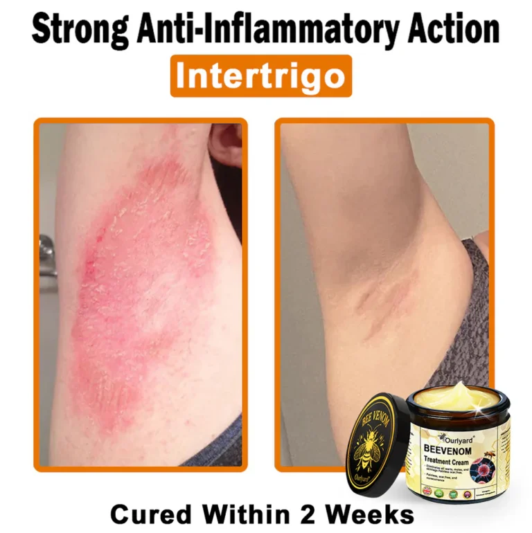 Ourlyard® Botulinum Toxin & Bee Venom Skin Treatment Cream 8 Ourlyard® Botulinum Toxin & Bee Venom Skin Treatment Cream