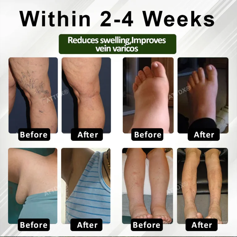 ATTDX® CircuHerb Edema Soothing & Healing Balm 5 ATTDX® CircuHerb Edema Soothing & Healing Balm