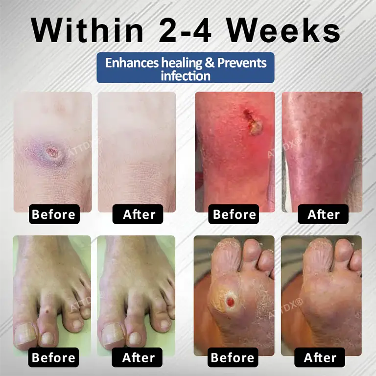 ATTDX® Diabetes Foot Guard Fast Recovery Spray 3 ATTDX® Diabetes Foot Guard Fast Recovery Spray