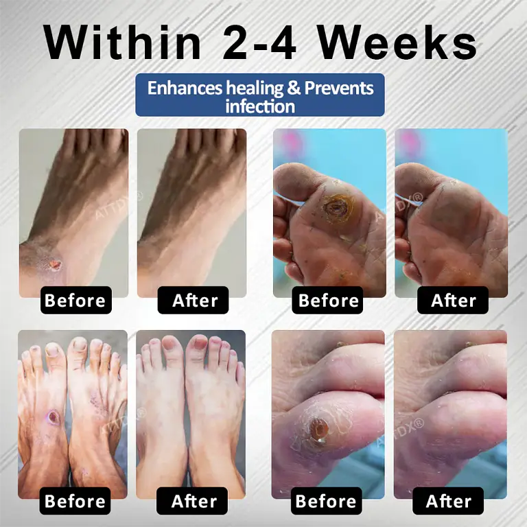 ATTDX® Diabetes Foot Guard Fast Recovery Spray 2 ATTDX® Diabetes Foot Guard Fast Recovery Spray