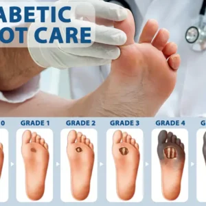 ATTDX® Diabetes Foot Guard Fast Recovery Spray 22 ATTDX® Diabetes Foot Guard Fast Recovery Spray