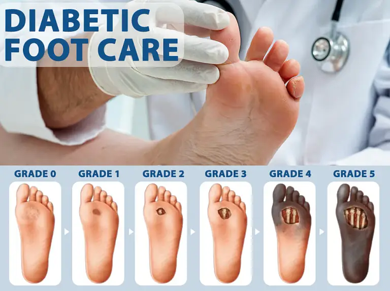 ATTDX® Diabetes Foot Guard Fast Recovery Spray 11 ATTDX® Diabetes Foot Guard Fast Recovery Spray