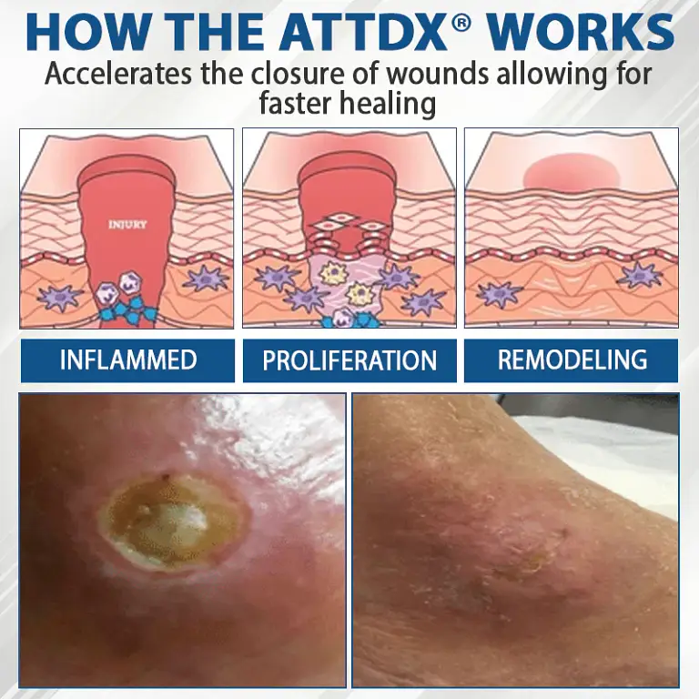 ATTDX® Diabetes Foot Guard Fast Recovery Spray 7 ATTDX® Diabetes Foot Guard Fast Recovery Spray