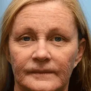 LOVILDS™ Botulin Bee Poison Wrinkle Removal Cream 25 LOVILDS™ Botulin Bee Poison Wrinkle Removal Cream