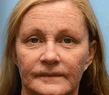 LOVILDS™ Botulin Bee Poison Wrinkle Removal Cream 5 LOVILDS™ Botulin Bee Poison Wrinkle Removal Cream