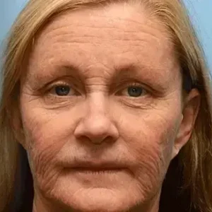 Furzero™ Botox Bee Venom Wrinkle Remover Cream 22 Furzero™ Botox Bee Venom Wrinkle Remover Cream