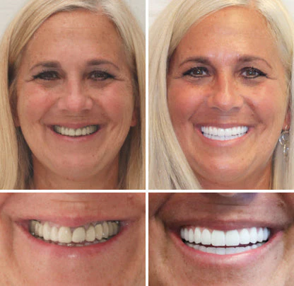 NESLEMY™ Advanced Customized Full Denture Set 8 NESLEMY™ Advanced Customized Full Denture Set