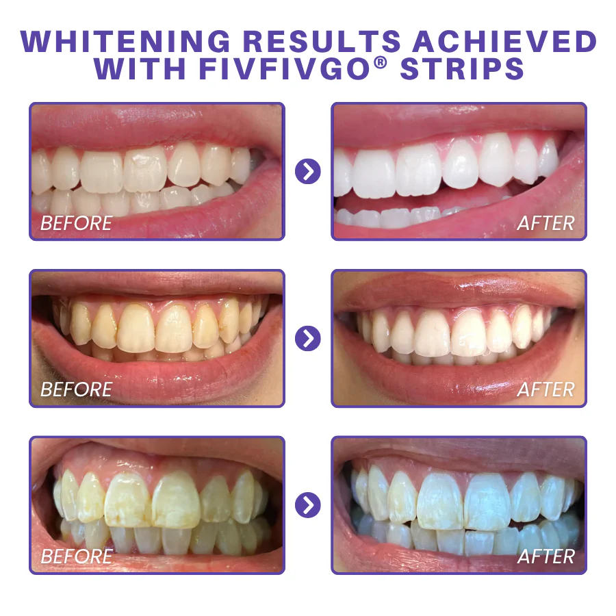 Fivfivgo® Purple Whitening Teeth Strips 6 Fivfivgo® Purple Whitening Teeth Strips