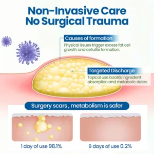 Cvreoz® BumpClear Lipoma Removal Cream 14 Cvreoz® BumpClear Lipoma Removal Cream