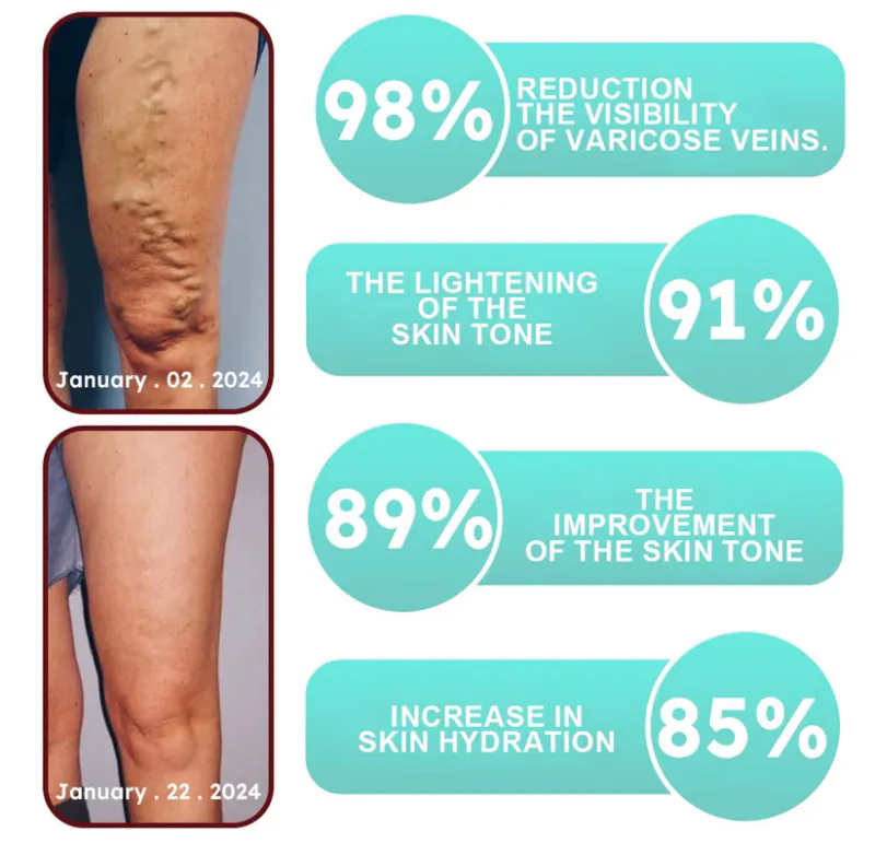 LOVILDS - Leech Varicose Veins Patch 10 LOVILDS - Leech Varicose Veins Patch