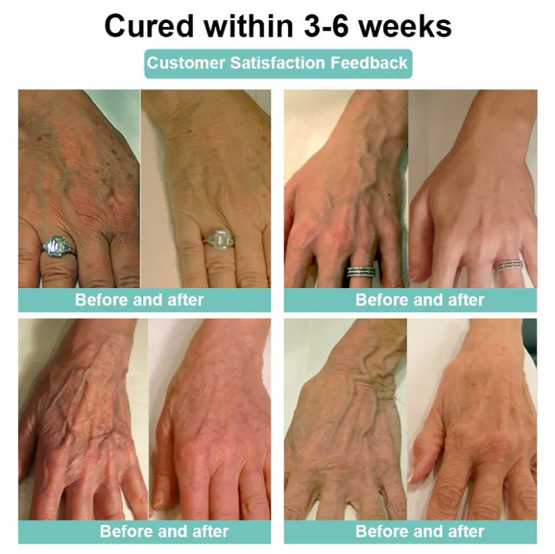 LOVILDS - Leech Varicose Veins Patch 3 LOVILDS - Leech Varicose Veins Patch