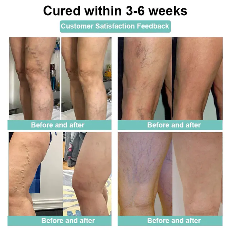 LOVILDS - Leech Varicose Veins Patch 6 LOVILDS - Leech Varicose Veins Patch