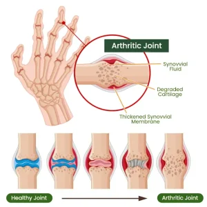 Adfire® Bee Venom Bone & Joint Revive Spray 13 Adfire® Bee Venom Bone & Joint Revive Spray