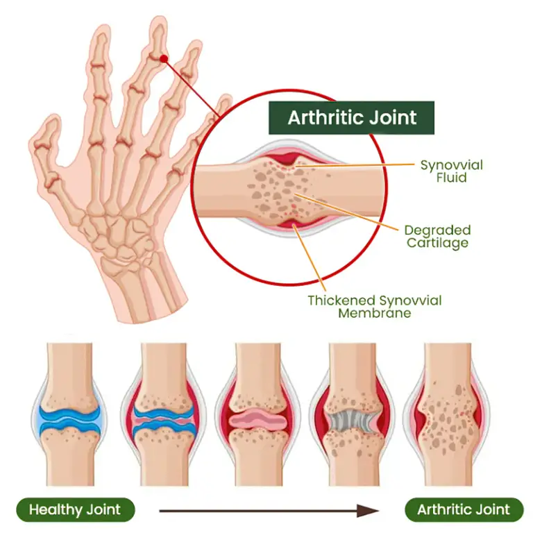 Adfire® Bee Venom Bone & Joint Revive Spray 4 Adfire® Bee Venom Bone & Joint Revive Spray