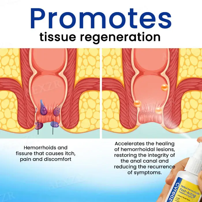 Cvreoz® Herbal Hemorrhoids Fast-Acting Treatment Spray 4 Cvreoz® Herbal Hemorrhoids Fast-Acting Treatment Spray